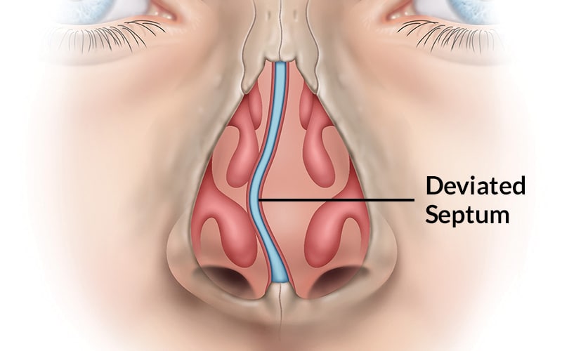 Painless Deviated Nasal Septum Treatment Hospital in AS Rao Nagar/Hyderabad