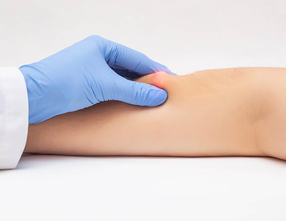 Lipoma Removal Surgery in Hyderabad 