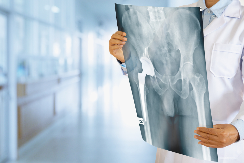 Best Hip Replacement Surgeon in Hyderabad