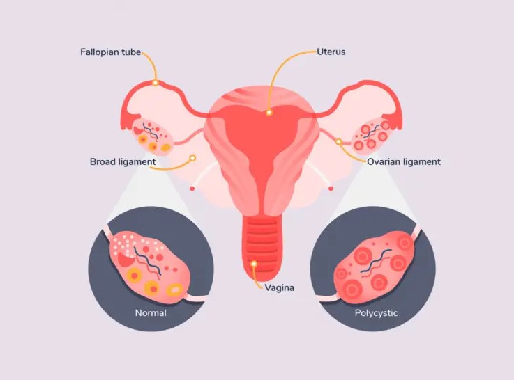 Painless PCOD Treatment Hospital in AS Rao Nagar/Hyderabad